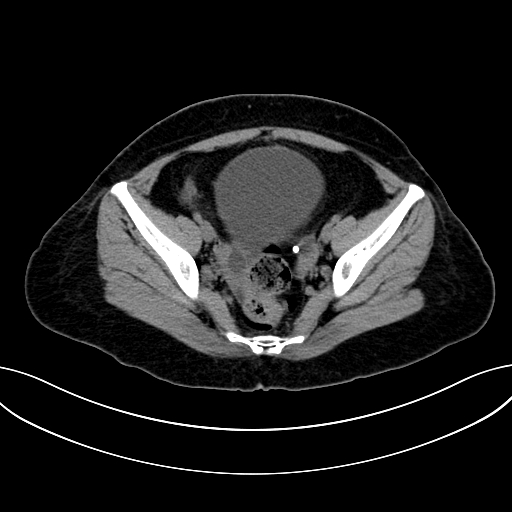 Adrenocortical carcinoma (Radiopaedia 87281-103569 Axial non-contrast 73).jpg