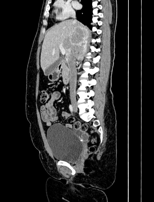 Adrenocortical carcinoma (Radiopaedia 87281-103569 Sagittal C+ portal venous phase 125).jpg
