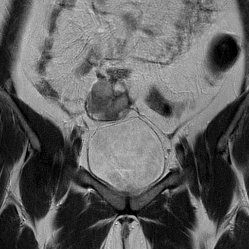 File:Adult granulosa cell tumor of the ovary (Radiopaedia 64991-73953 Coronal T2 6).jpg