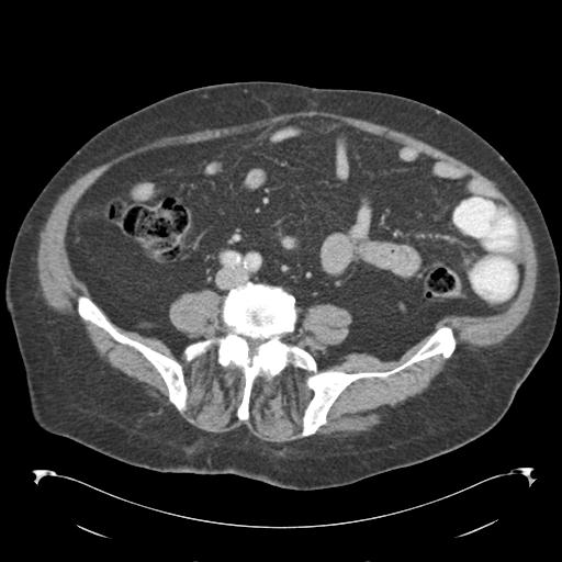 Adult ileal intussusception with secondary obstruction (Radiopaedia 30395-31051 Axial C+ portal venous phase 49).jpg