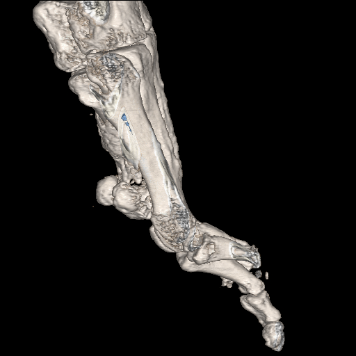 File:Advanced osteomyelitis due to open metatarsal fracture (Radiopaedia 83891-99095 VRT 24).jpg