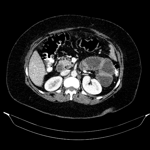 File:Afferent loop syndrome - secondary to incarcerated trocar site hernia (Radiopaedia 82959-97305 Axial C+ portal venous phase 88).jpg