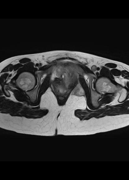 File:Aggressive angiomyxoma of the pelvis and perineum (Radiopaedia 59162-66479 Axial T2 5).jpg