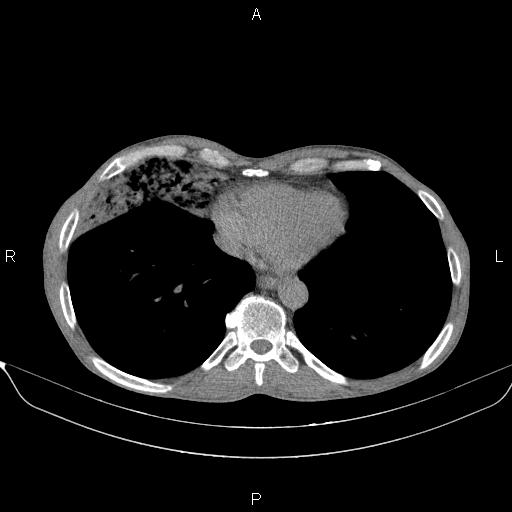 Air bronchogram in pneumonia (Radiopaedia 85719-101512 Axial non-contrast 50).jpg