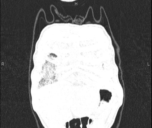 Air bronchogram in pneumonia (Radiopaedia 85719-101512 Coronal lung window 4).jpg