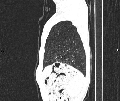 File:Air bronchogram in pneumonia (Radiopaedia 85719-101512 Sagittal lung window 90).jpg