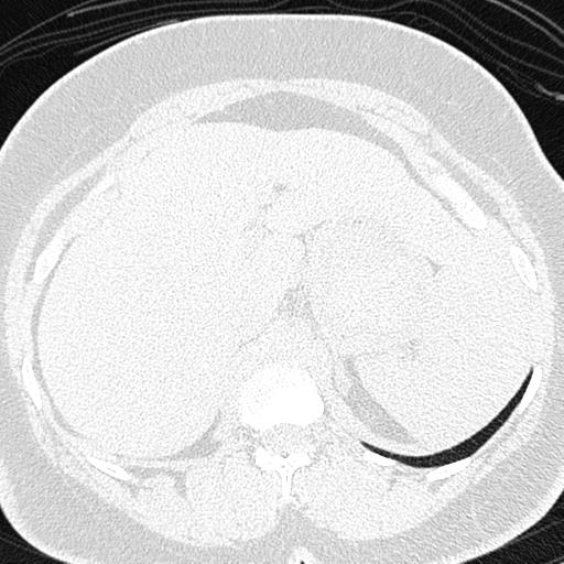 File:Air trapping in small airway disease (Radiopaedia 61685-69694 Axial lung window 196).jpg