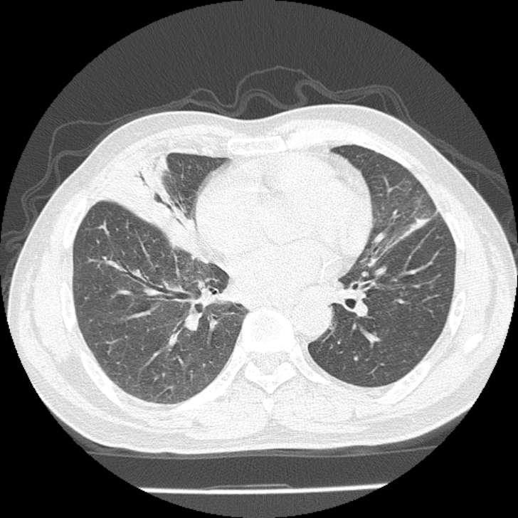 Airway foreign body in adult (Radiopaedia 85907-101779 Axial lung window 112).jpg