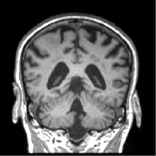 Alzheimer disease and cerebral amyloid angiopathy (Radiopaedia 64234-73011 Coronal T1 19).png