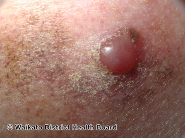 File:Amelanotic melanoma (DermNet NZ amelanotic-melanoma-027).jpg