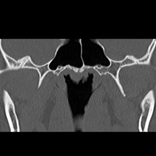 File:Ameloblastic fibro-odontoma (Radiopaedia 18843-18780 B 25).jpg