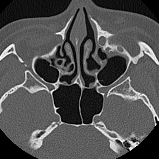 File:Ameloblastic fibro-odontoma (Radiopaedia 18843-18780 C 4).jpg