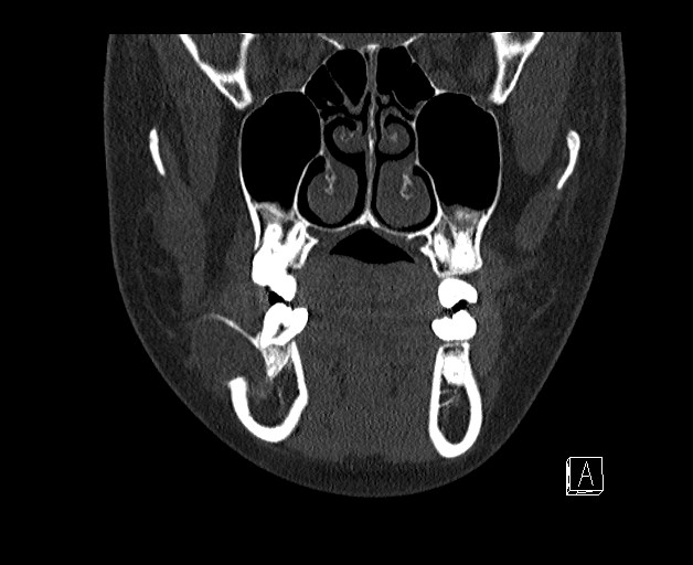 File:Ameloblastoma (Radiopaedia 26645-26793 bone window 2).jpg