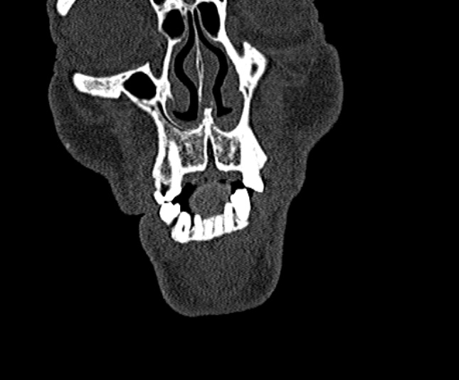 Ameloblastoma (Radiopaedia 51921-57766 Coronal bone window 25).jpg