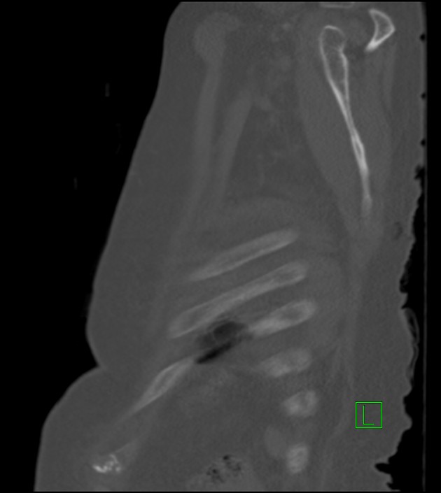Amiodarone deposition in the liver (Radiopaedia 77587-89780 Sagittal bone window 16).jpg
