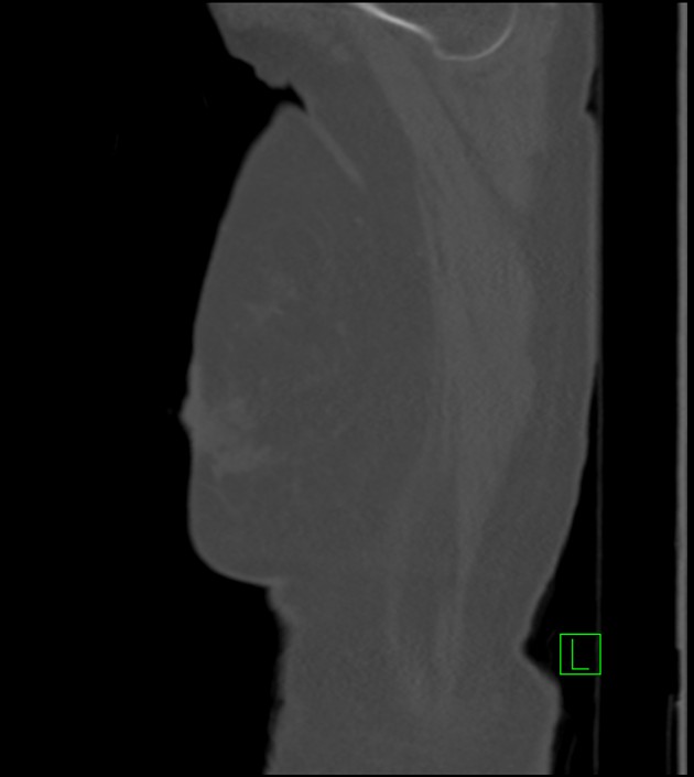 Amiodarone deposition in the liver (Radiopaedia 77587-89780 Sagittal bone window 94).jpg