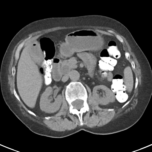 File:Ampullary adenocarcinoma (Radiopaedia 34013-35237 Axial non-contrast 21).png