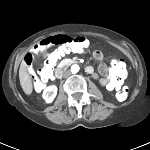 File:Ampullary adenocarcinoma (Radiopaedia 34013-35237 B 45).png