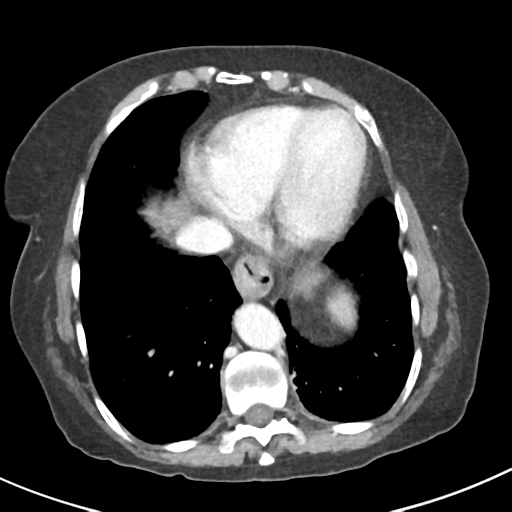 Ampullary adenocarcinoma (Radiopaedia 34013-35237 C 3).png