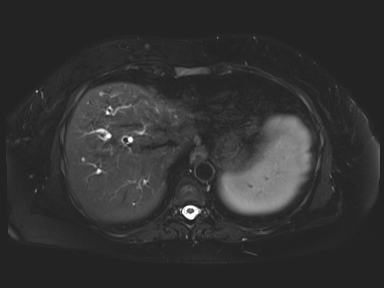 Ampullary adenocarcinoma (Radiopaedia 54765-61014 Axial T2 space-FS 12).jpg