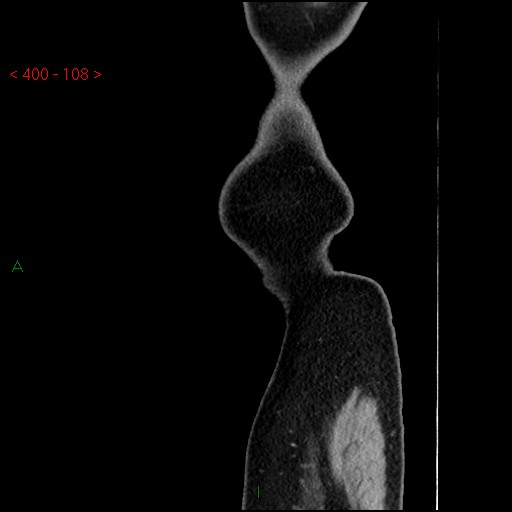 File:Ampullary carcinoma (Radiopaedia 56396-63056 D 107).jpg