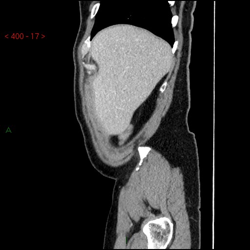 Ampullary carcinoma (Radiopaedia 56396-63056 D 16).jpg