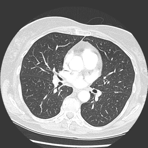 Amyloidosis - bronchial and diffuse nodular pulmonary involvement (Radiopaedia 60156-67745 Axial lung window 41).jpg