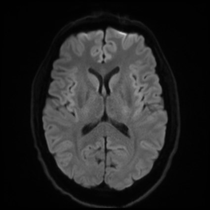 File:Amyotrophic lateral sclerosis (Radiopaedia 87352-103658 Axial DWI 43).jpg