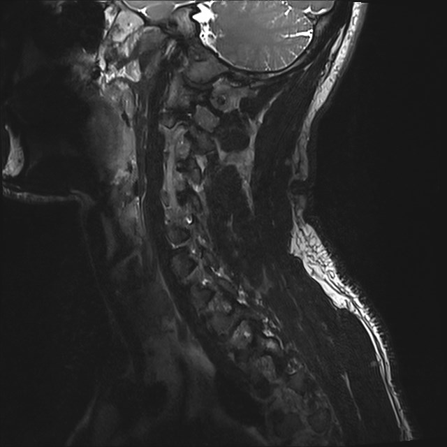 Amyotrophic lateral sclerosis (Radiopaedia 87352-103658 I 51).jpg