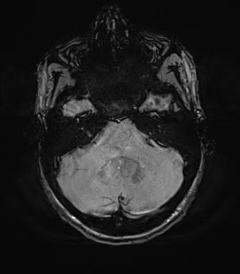 File:Anaplastic astrocytoma IDH mutant (Radiopaedia 50046-55341 Axial SWI 22).png