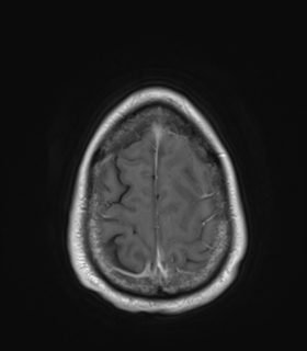 File:Anaplastic astrocytoma IDH wild-type (Radiopaedia 49984-55273 Axial T1 C+ 50).png