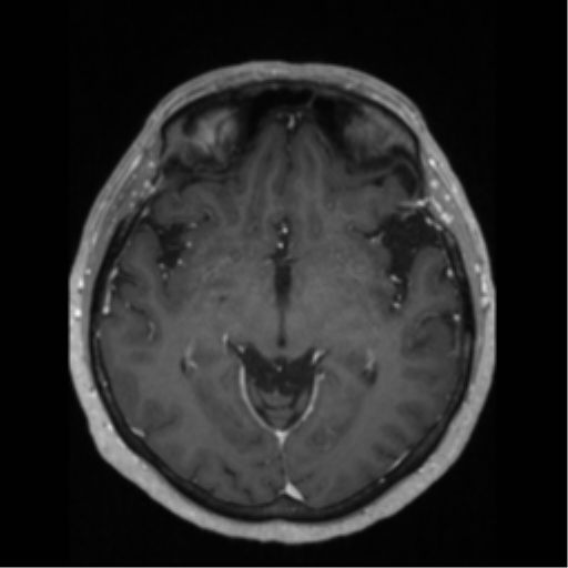 File:Anaplastic astrocytoma IDH wild-type (pseudoprogression) (Radiopaedia 42209-45276 Axial T1 C+ 69).png