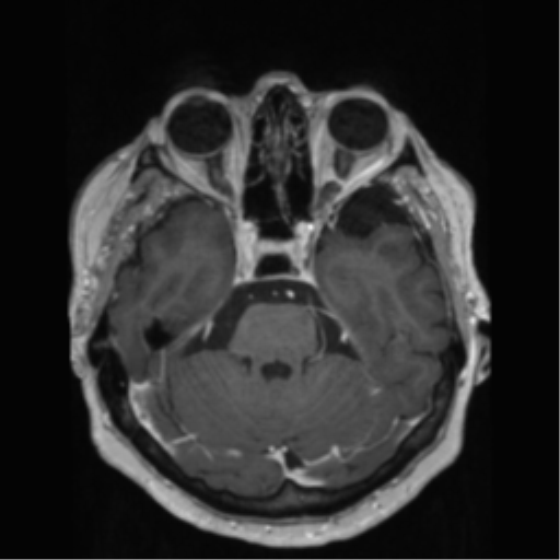 File:Anaplastic astrocytoma IDH wild-type (pseudoprogression) (Radiopaedia 42209-45278 Axial T1 C+ 57).png
