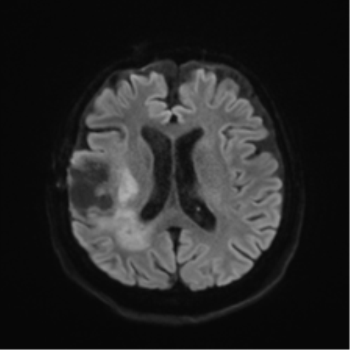 Anaplastic astrocytoma IDH wild-type (pseudoprogression) (Radiopaedia 42209-45279 Axial DWI 43).png