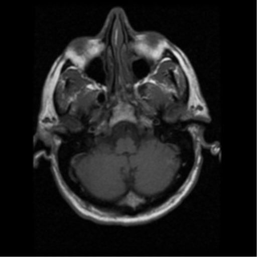 File:Anaplastic meningioma with recurrence (Radiopaedia 34452-35783 Axial T1 3).png