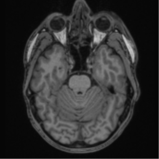 Anaplastic oligodendroglioma with skull fracture (Radiopaedia 74831-85845 Axial T1 18).png