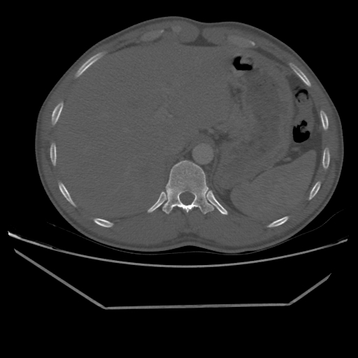 Aneurysmal bone cyst - rib (Radiopaedia 82167-96220 Axial bone window 231).jpg