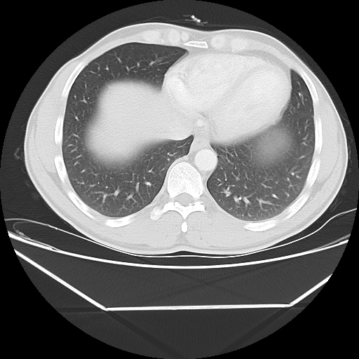 Aneurysmal bone cyst - rib (Radiopaedia 82167-96220 Axial lung window 49).jpg