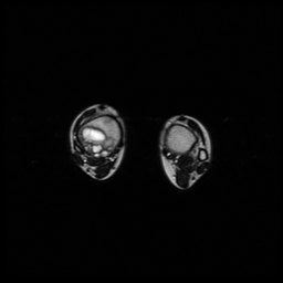 File:Aneurysmal bone cyst - tibia (Radiopaedia 22343-22367 Axial T2 14).jpg