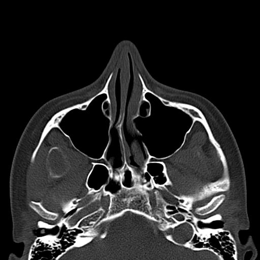 Aneurysmal bone cyst of the mandible (Radiopaedia 43280-46601 Axial bone window 75).jpg