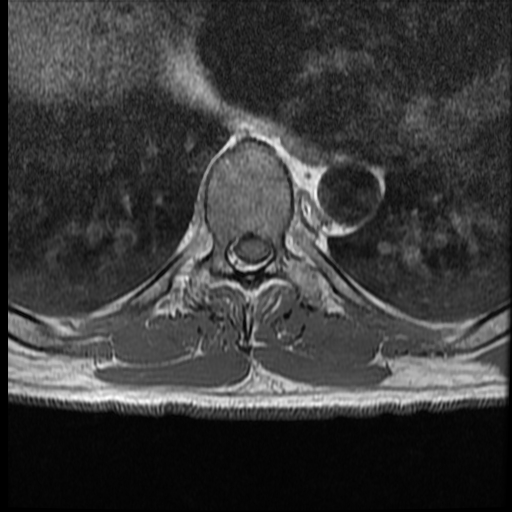 File:Angiolipoma - thoracic spine (Radiopaedia 28242-28479 Axial T1 2).jpg
