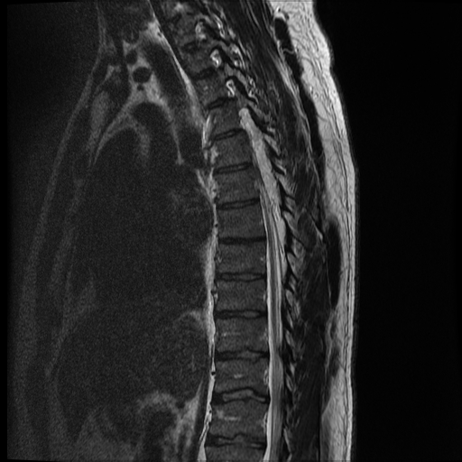 File:Angiolipoma - thoracic spine (Radiopaedia 28242-28479 Sagittal T2 9).jpg