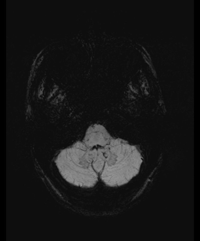 Angiomatous meningioma (Radiopaedia 79459-92579 E 8).jpg