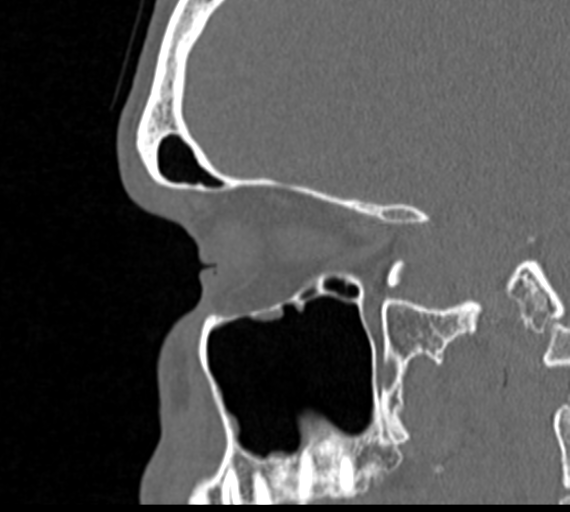 Angular epidermoid cyst (Radiopaedia 46908-51439 Sagittal bone window 25).png
