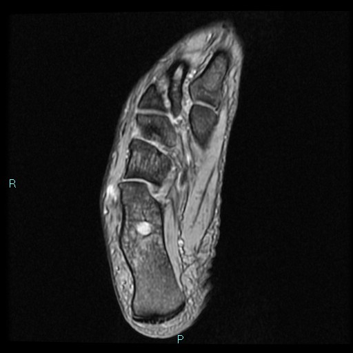 Ankle ganglion cyst (Radiopaedia 62809-71162 Axial Gradient Echo 19).jpg