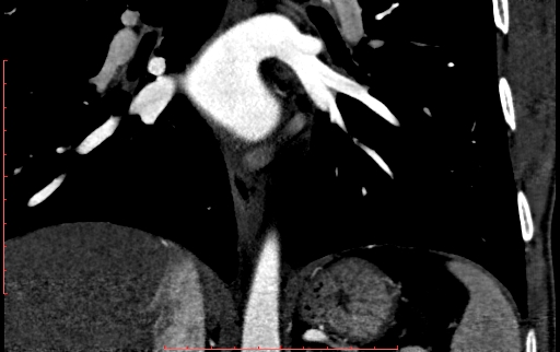 Anomalous left coronary artery from the pulmonary artery (ALCAPA) (Radiopaedia 70148-80181 B 230).jpg