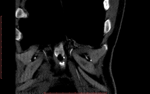 Anomalous left coronary artery from the pulmonary artery (ALCAPA) (Radiopaedia 70148-80181 B 31).jpg
