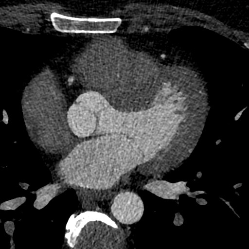 File:Anomalous origin of the left coronary artery with malignant course (Radiopaedia 77842-90126 C 120).jpeg