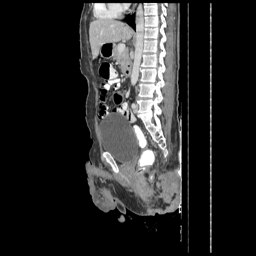Anorectal carcinoma (Radiopaedia 44413-48064 C 57).jpg
