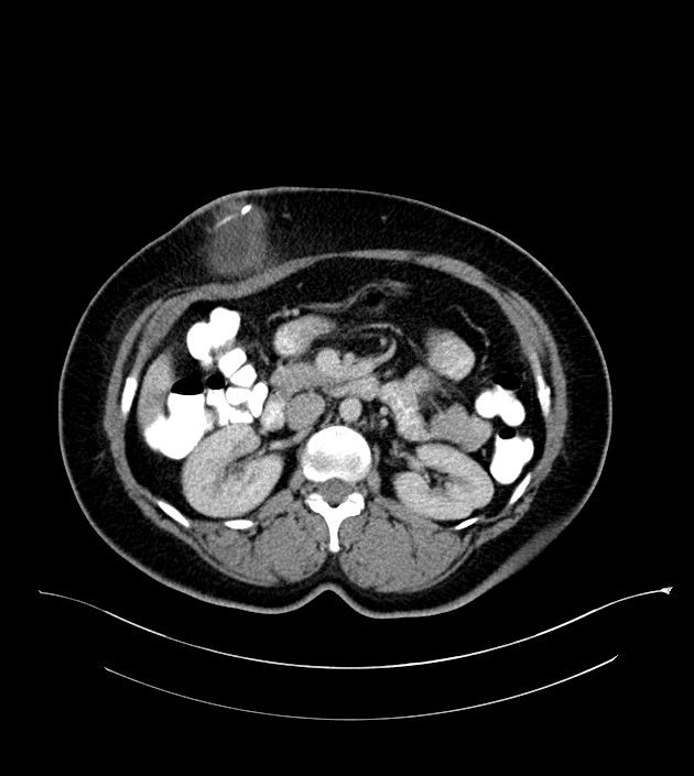 Anterior abdominal wall CSF pseudocyst (CSFoma) (Radiopaedia 79453-92571 A 39).jpg